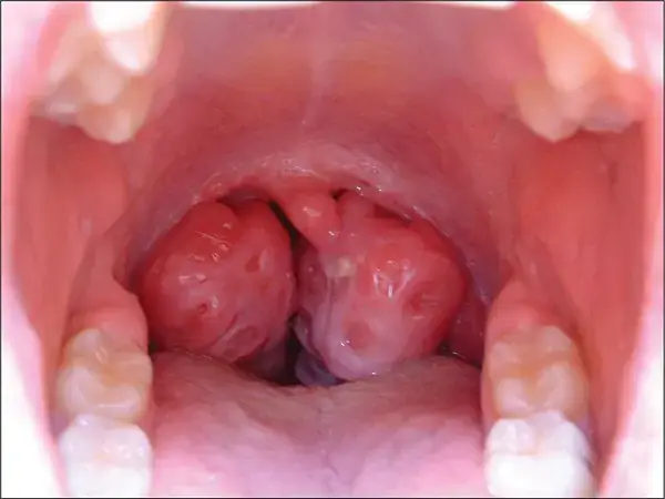 Amidan Quá Phát Là Gì? Nguyên Nhân, Triệu Chứng Và Cách Xử Trí Hiệu Quả