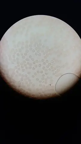 Acanthocyte Là Gì? Phân Biệt Và Vai Trò Trong Chẩn Đoán Y Tế