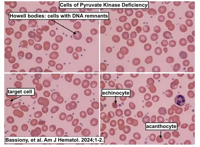 Acanthocyte Là Gì? Phân Biệt Và Vai Trò Trong Chẩn Đoán Y Tế