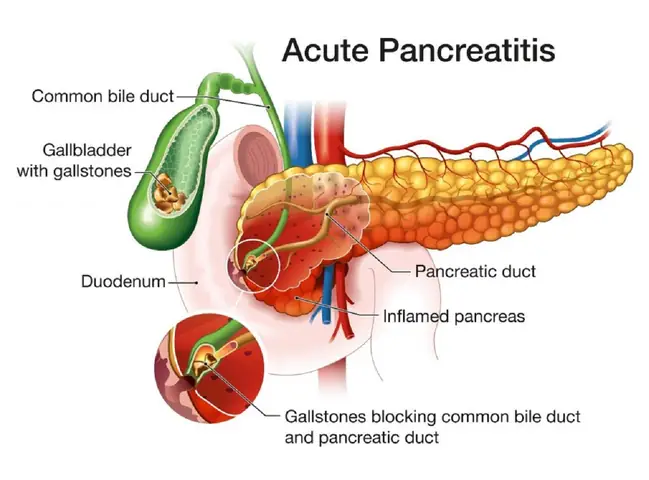 Viêm Tụy Cấp (acute Pancreatitis) Là Gì? Nguyên Nhân, Triệu Chứng Và Cách Điều Trị