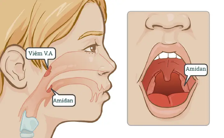 Ung Thư Biểu Mô Nang Tuyến (adenoid Cystic Carcinoma - Acc): Định Nghĩa, Triệu Chứng Và Chẩn Đoán
