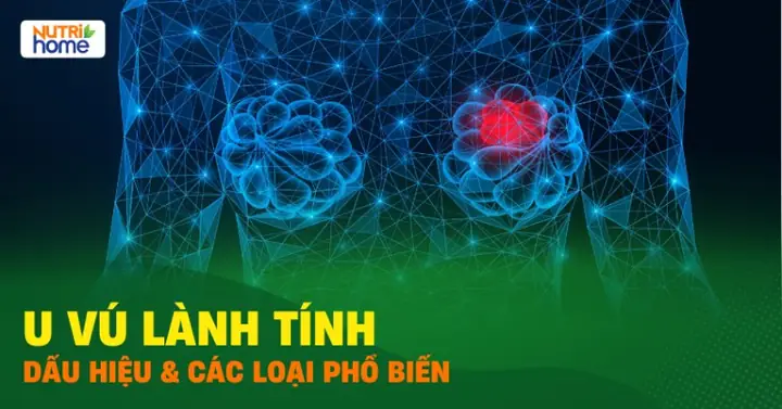 Adenosis Tuyến Vú Là Gì? Nguyên Nhân, Triệu Chứng Và Khi Nào Cần Gặp Bác Sĩ