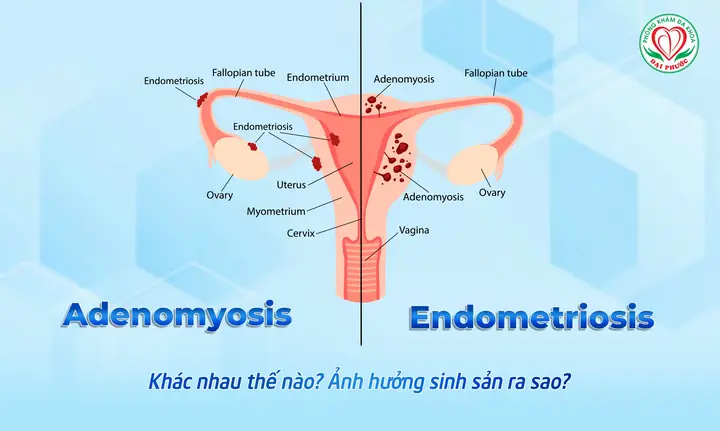 Adenosis Tuyến Vú Là Gì? Nguyên Nhân, Triệu Chứng Và Khi Nào Cần Gặp Bác Sĩ