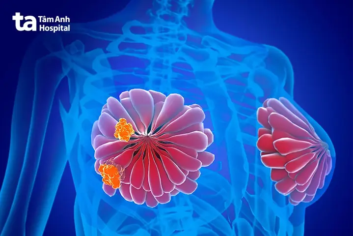 Adenosis Tuyến Vú Là Gì? Nguyên Nhân, Triệu Chứng Và Khi Nào Cần Gặp Bác Sĩ