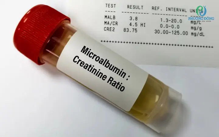 Tỷ Lệ Albumin/creatinin (acr): Chỉ Số Vàng Đánh Giá Chức Năng Thận