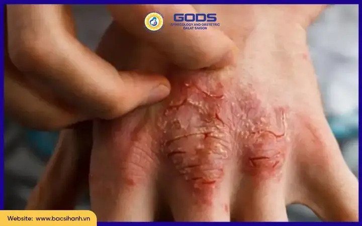 Phản Ứng Dị Ứng Là Gì? Nguyên Nhân, Triệu Chứng Và Cách Xử Lý An Toàn