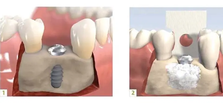 Allograft Là Gì? Phân Loại, Ưu Nhược Điểm Và Ứng Dụng Trong Y Tế