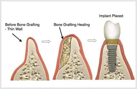Allograft Là Gì? Phân Loại, Ưu Nhược Điểm Và Ứng Dụng Trong Y Tế