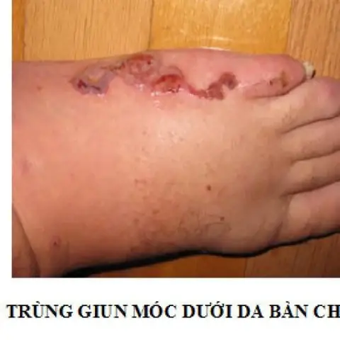 Ancylostoma Caninum Là Gì? Giải Đáp Chi Tiết Về Ký Sinh Trùng Gây Bệnh