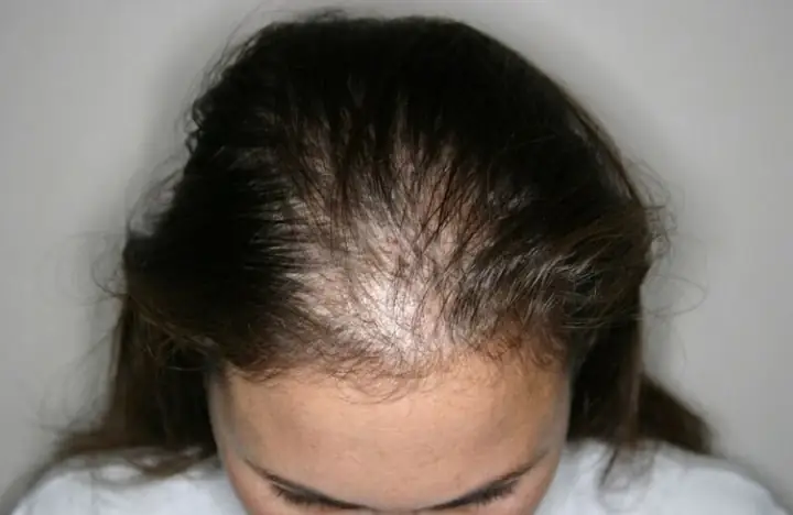 Androgenetic Alopecia Là Gì? Nguyên Nhân, Triệu Chứng Và Cách Điều Trị Hiệu Quả