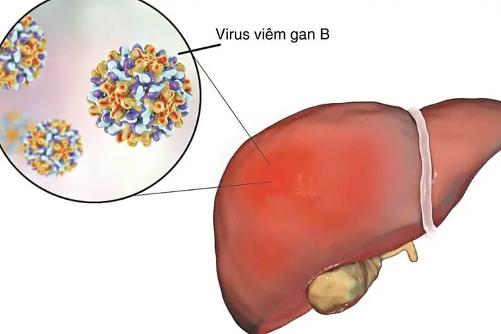 Anti Hbs 1000 Là Gì? Ý Nghĩa Chỉ Số Và Mức Độ An Toàn Khi Xét Nghiệm Viêm Gan B