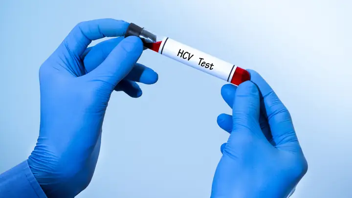 Anti Hcv Negative Là Gì? Ý Nghĩa, Khi Nào Cần Xét Nghiệm Và Cách Đọc Kết Quả Anti Hcv Negative Là Gì? Ý Nghĩa, Khi Nào Cần Xét Nghiệm Và Cách Đọc Kết Quả
