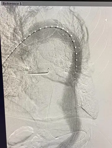 Bóc Tách Động Mạch Chủ (aortic Dissection) Là Gì? Nguyên Nhân, Triệu Chứng Và Cách Điều Trị
