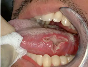 Loét Áp Tơ Miệng (aphthous Ulcer): Nguyên Nhân, Dấu Hiệu Và Cách Xử Trí Hiệu Quả