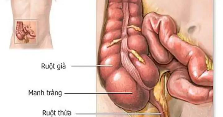 Appendectomy Là Gì? Phẫu Thuật Cắt Ruột Thừa Và Những Điều Cần Biết