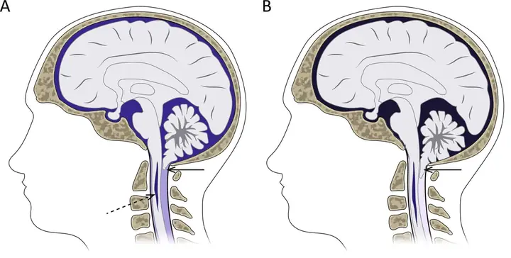 Hội Chứng Arnold Chiari Là Gì? Nguyên Nhân, Phân Loại Và Triệu Chứng