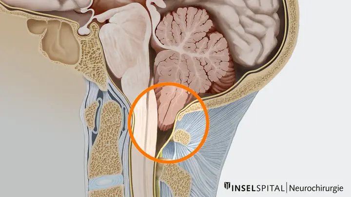 Hội Chứng Arnold Chiari Là Gì? Nguyên Nhân, Phân Loại Và Triệu Chứng