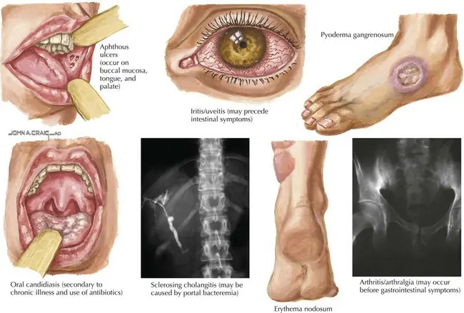 Arthralgia Là Gì? Nguyên Nhân, Triệu Chứng Và Cách Điều Trị Đau Khớp