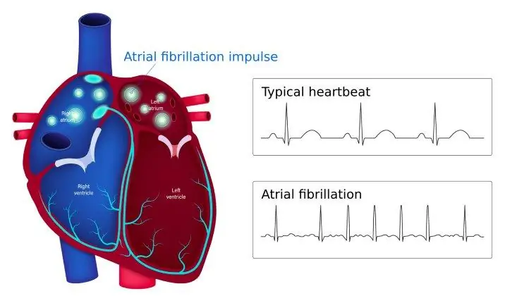 Atrial Là Gì? Định Nghĩa, Ý Nghĩa Và Các Thuật Ngữ Y Khoa Liên Quan