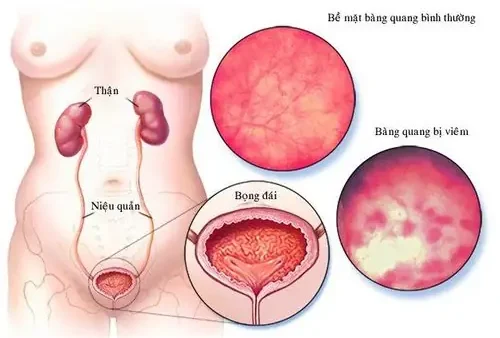 Bạch Cầu Niệu 3 Là Gì? Nguyên Nhân, Ý Nghĩa Và Khi Nào Cần Gặp Bác Sĩ