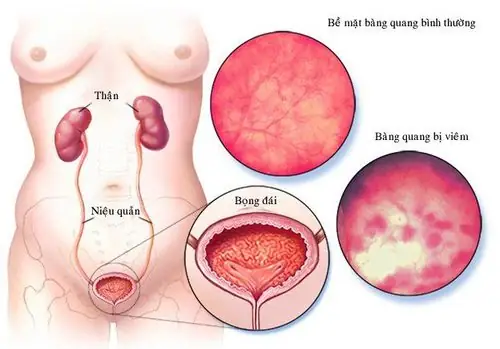 Bạch Cầu Niệu 3 Là Gì? Nguyên Nhân, Ý Nghĩa Và Khi Nào Cần Gặp Bác Sĩ