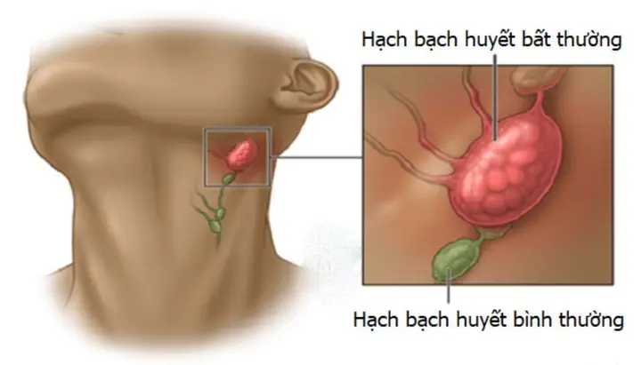 Bạch Cầu Là Gì? Vai Trò, Cấu Tạo Và Chỉ Số Cần Biết