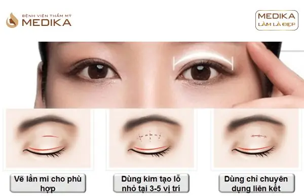 Bấm Mí Hàn Quốc Là Gì? Giải Đáp Mọi Thắc Mắc Về Phương Pháp Tạo Mắt Hai Mí Tự Nhiên