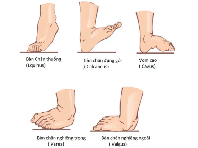 Bàn Chân Thuổng Là Gì? Nguyên Nhân, Dấu Hiệu Và Cách Điều Trị Hiệu Quả