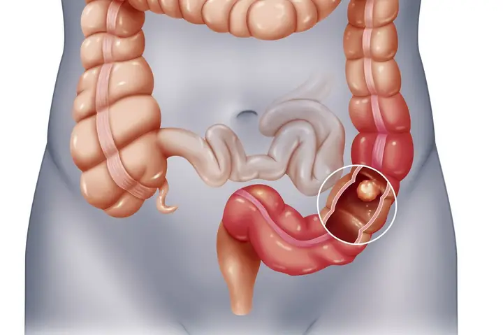 Bán Tắc Ruột Là Gì? Dấu Hiệu Nhận Biết, Nguyên Nhân Và Cách Xử Lý