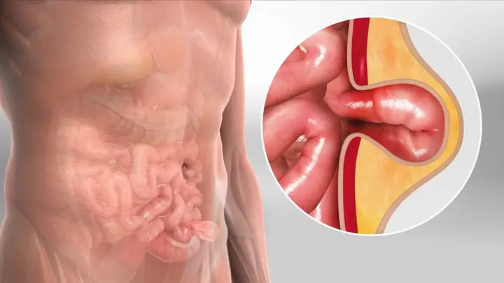 Bán Tắc Ruột Là Gì? Dấu Hiệu Nhận Biết, Nguyên Nhân Và Cách Xử Lý
