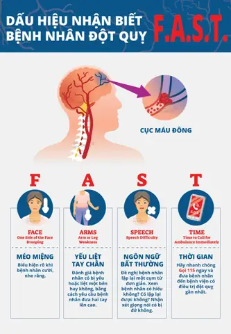 BE FAST Là Gì? Hướng Dẫn Nhận Biết Sớm Dấu Hiệu Đột Quỵ Hiệu Quả