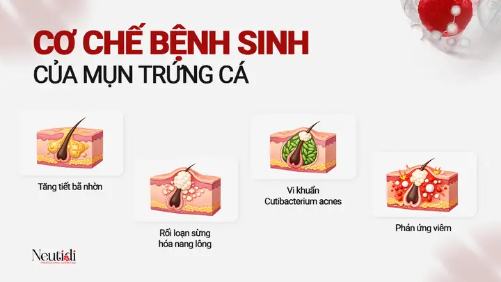 Acne Là Gì? Nguyên Nhân, Biểu Hiện Và Cách Nhận Biết Sớm Bệnh Trứng Cá
