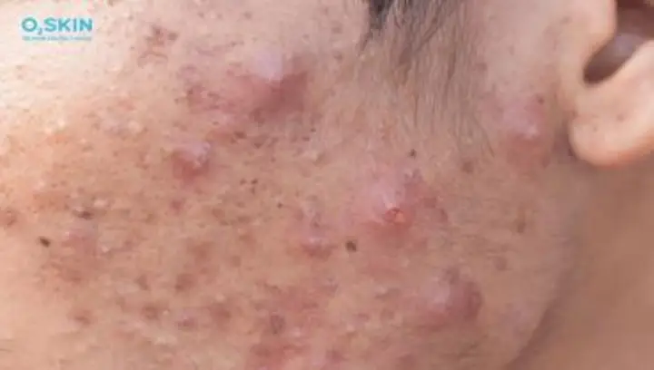Acne Là Gì? Nguyên Nhân, Biểu Hiện Và Cách Nhận Biết Sớm Bệnh Trứng Cá