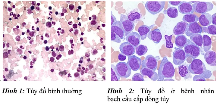 Bạch Cầu Cấp Dòng Tủy (AML) Là Gì? Nguyên Nhân, Triệu Chứng & Cách Chẩn Đoán