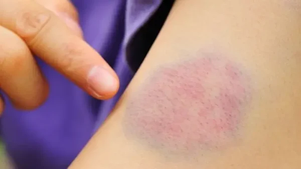 Bạch Cầu Cấp Dòng Tủy (AML) Là Gì? Nguyên Nhân, Triệu Chứng & Cách Chẩn Đoán