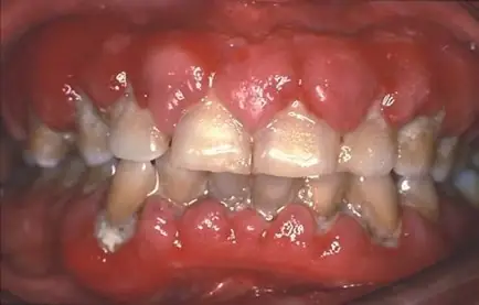 Bệnh Bạch Cầu Cấp: Định Nghĩa, Nguyên Nhân, Triệu Chứng & Cách Chẩn Đoán