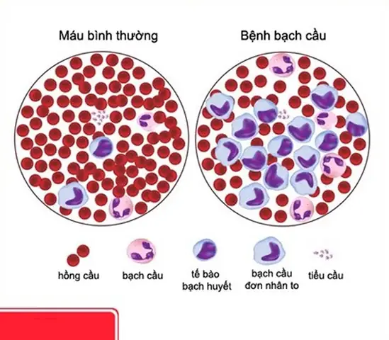 Bệnh Bạch Cầu Đơn Nhân Là Gì? Nguyên Nhân, Triệu Chứng Và Cách Điều Trị