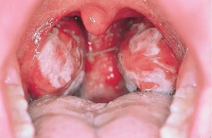 Bệnh Bạch Cầu Đơn Nhân Là Gì? Nguyên Nhân, Triệu Chứng Và Cách Điều Trị