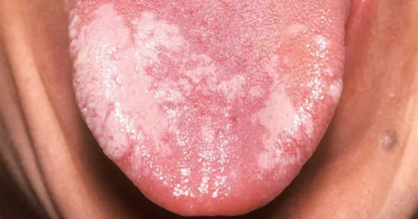 Bệnh Bạch Sản Là Gì? Nguyên Nhân, Triệu Chứng Và Cách Phòng Trị