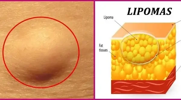 Bướu Mỡ (U Mỡ) Là Gì? Nguyên Nhân, Dấu Hiệu Và Cách Điều Trị Hiệu Quả