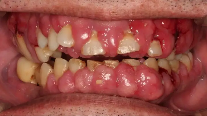 Cam Tẩu Mã Là Gì? Nguyên Nhân, Triệu Chứng Và Cách Điều Trị Bệnh Hoại Thư Vùng Mặt Cam Tẩu Mã Là Gì? Nguyên Nhân, Triệu Chứng Và Cách Điều Trị Bệnh Hoại Thư Vùng Mặt