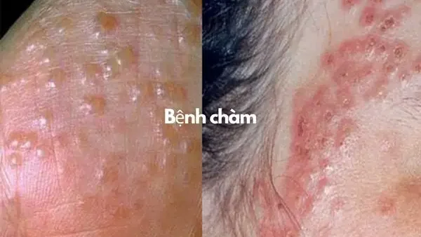 Bệnh Chàm Eczema Là Gì? Nguyên Nhân, Triệu Chứng Và Cách Điều Trị Hiệu Quả