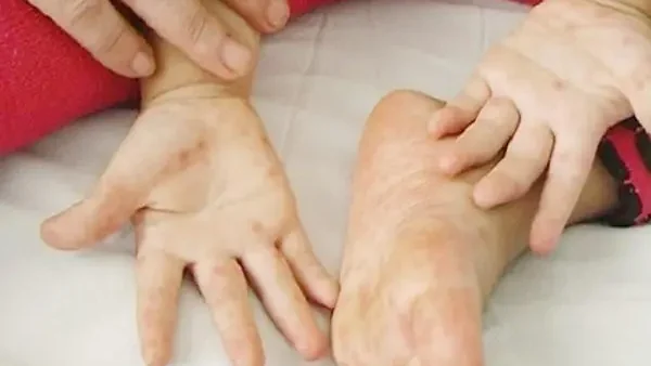 Bệnh Chân Tay Miệng Là Gì? Nguyên Nhân, Dấu Hiệu Và Cách Xử Lý