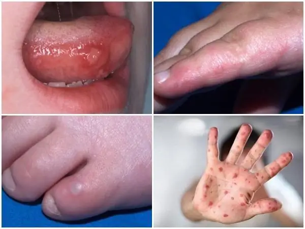 Bệnh Chân Tay Miệng Là Gì? Nguyên Nhân, Dấu Hiệu Và Cách Xử Lý