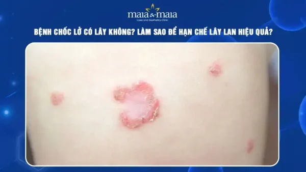 Bệnh Chốc Lây Là Gì? Nguyên Nhân, Triệu Chứng, Cách Điều Trị Và Phòng Ngừa Hiệu Quả