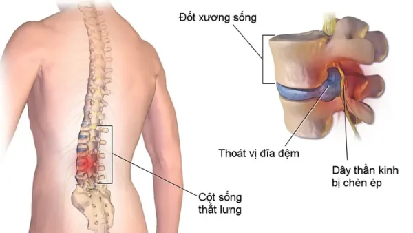 Bệnh Đĩa Đệm Là Gì? Nguyên Nhân, Triệu Chứng, Cách Điều Trị & Phòng Ngừa Hiệu Quả