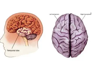 Bệnh Fahr Là Gì? Nguyên Nhân, Triệu Chứng Và Cách Chẩn Đoán, Điều Trị