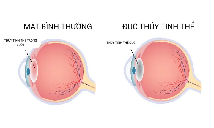 Bệnh Già Là Gì? Nguyên Nhân, Dấu Hiệu Và Cách Chăm Sóc Người Cao Tuổi