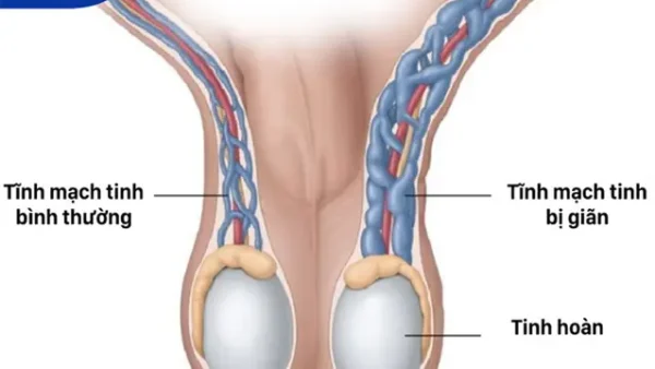 Giãn Tĩnh Mạch Thừng Tinh: Nguyên Nhân, Triệu Chứng Và Phương Pháp Điều Trị Toàn Diện