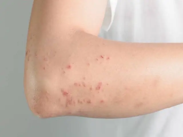 Bệnh Giun Đũa Chó Là Gì? Nguyên Nhân, Dấu Hiệu Và Cách Phòng Ngừa Hiệu Quả